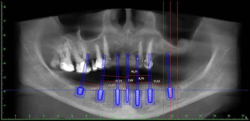 Surgical implant planning service dental lab